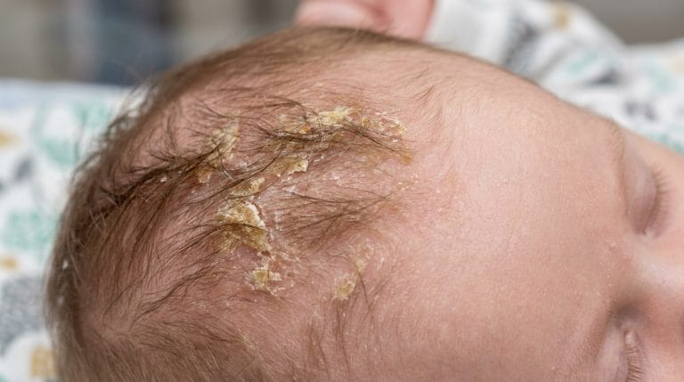 what causes cradle cap