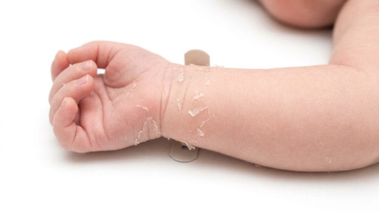 baby skin peeling newborn
